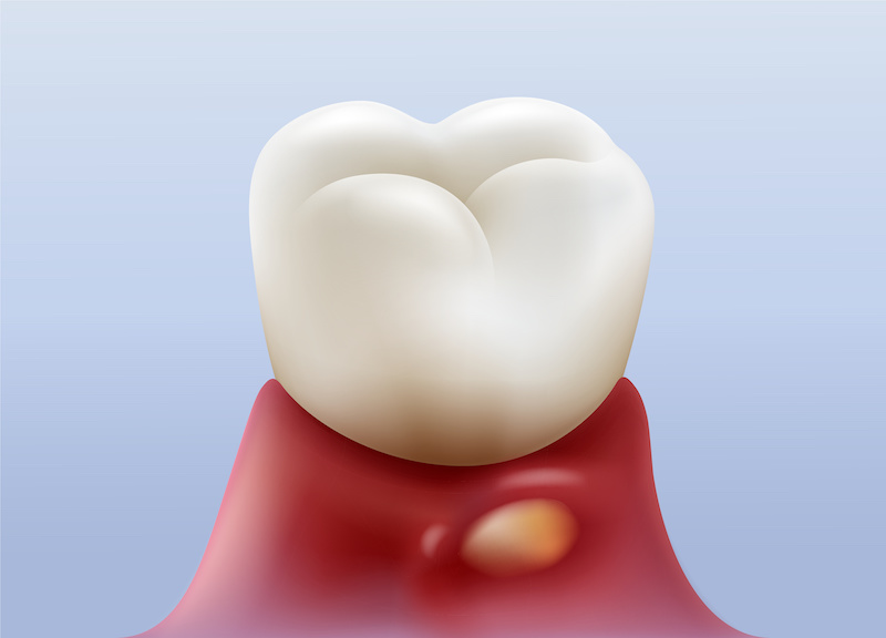 歯の根に膿が溜まるイメージ