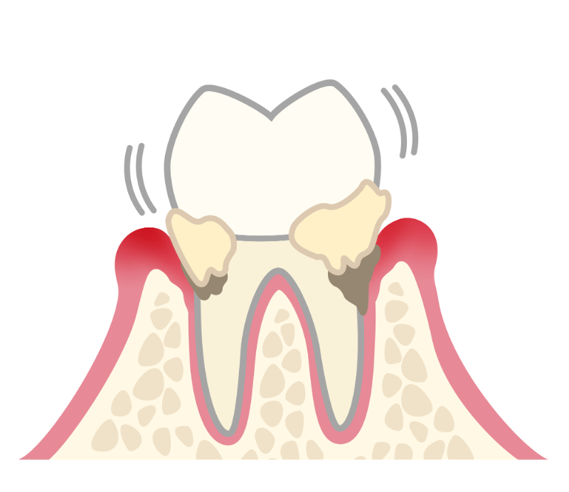 歯周病イメージ