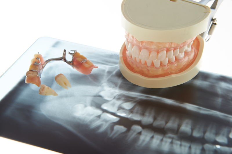 虫歯治療で抜歯した後の選択肢として入れ歯などのイメージ