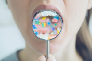 二次カリエスを患った口内環境の様子