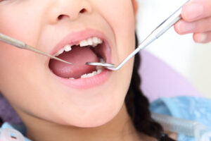 歯が生え変わっている途中の子どもの口