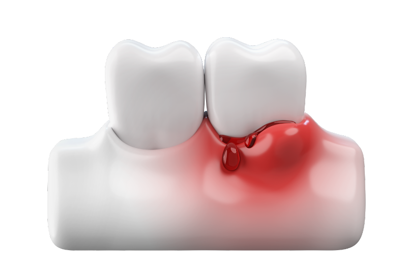 歯周病の歯ぐき