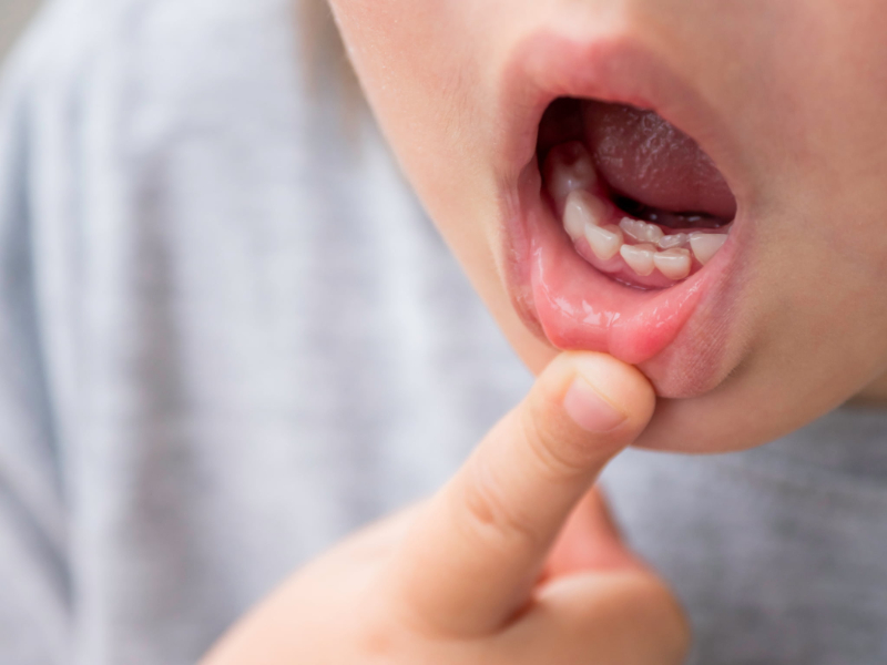 乳歯の下から永久歯が生えてきている様子