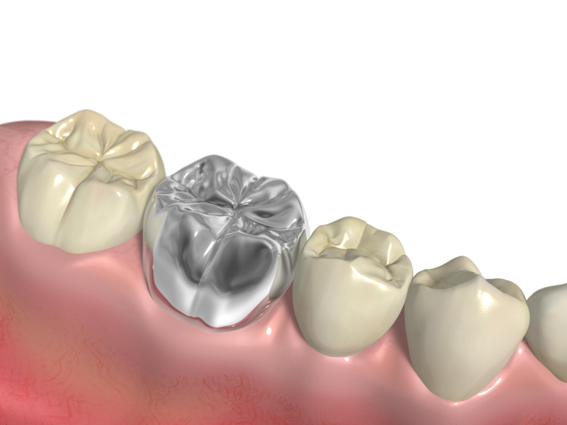 銀歯のある口腔内のイメージ