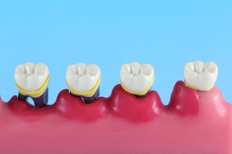 歯周病が進行していく様子の模型