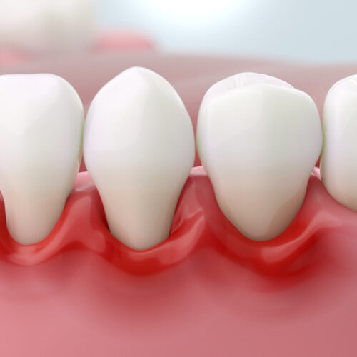 歯周病になっている歯